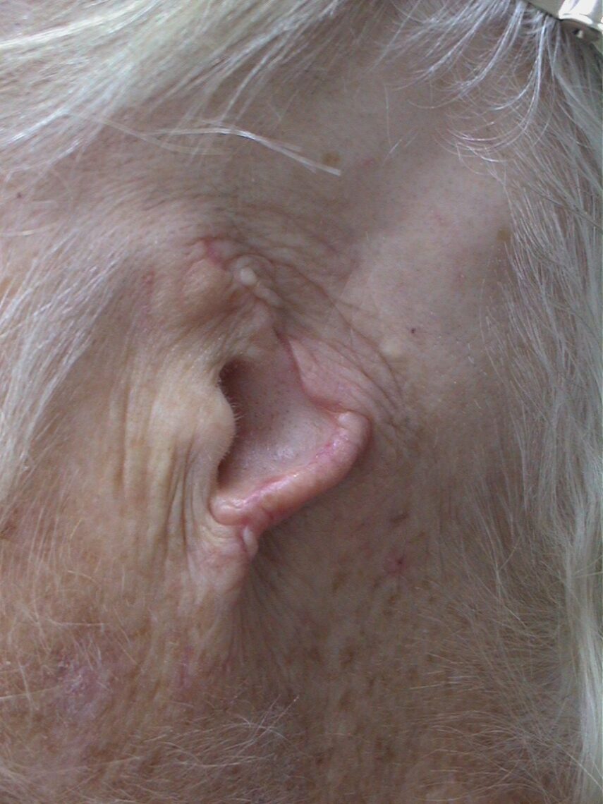 A close up of an older person 's auriculectomy