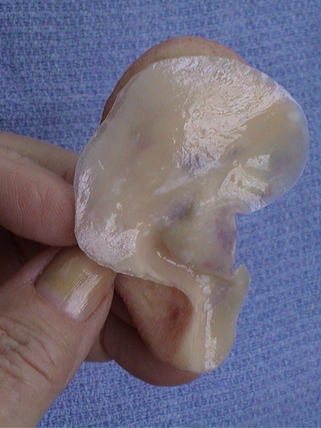 Prosthetic ear