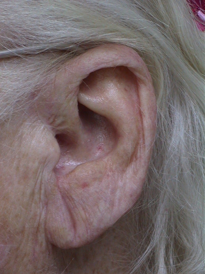Prosthetic ear, close-up
