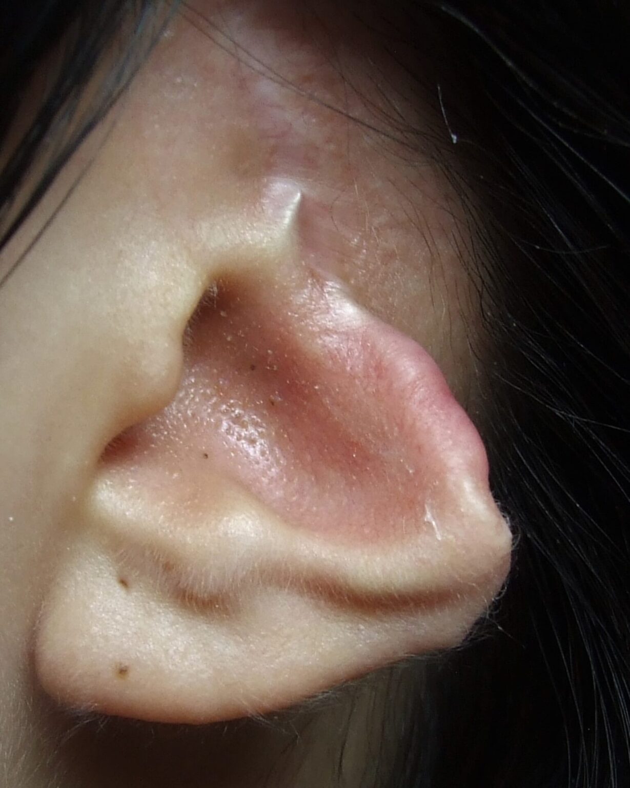Ear prosthetics microtia