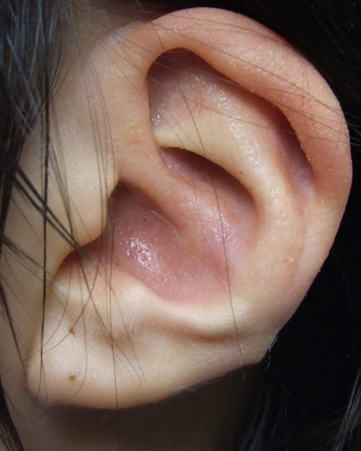 Microtia ear prosthetics