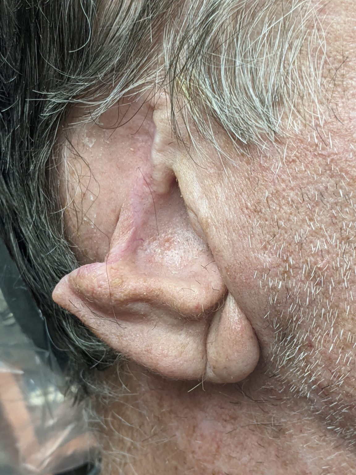 Microtia Ear Prosthetics