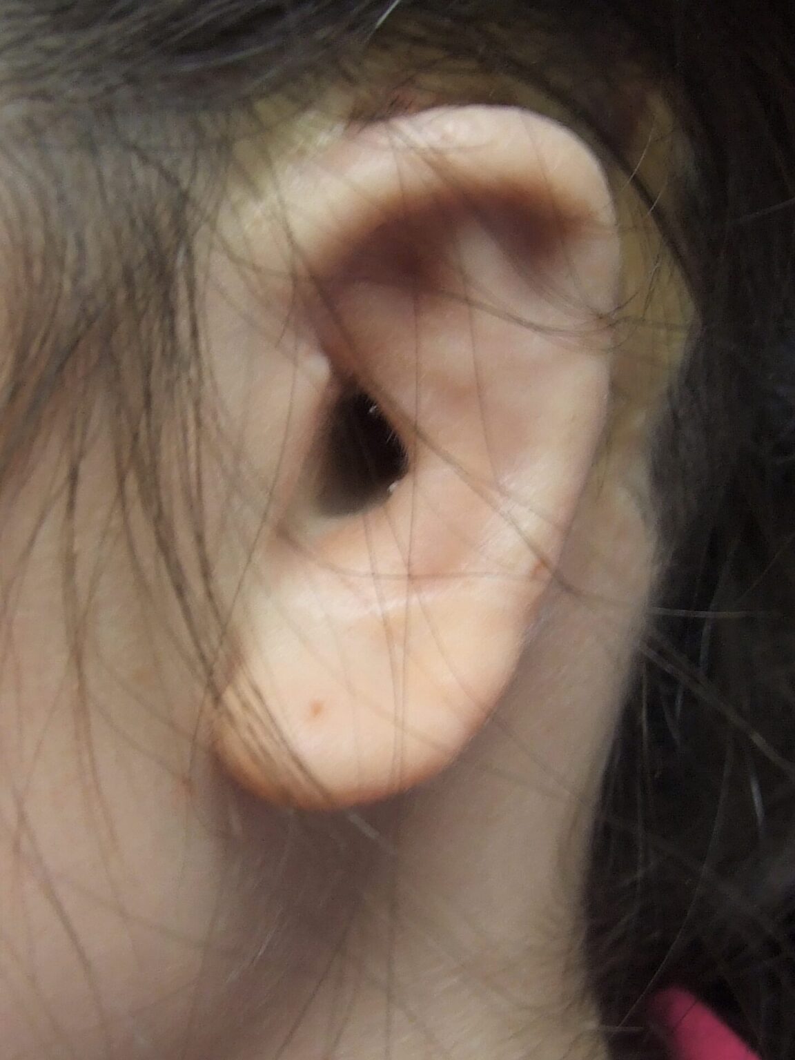 Microtia Ear Prosthetics ear