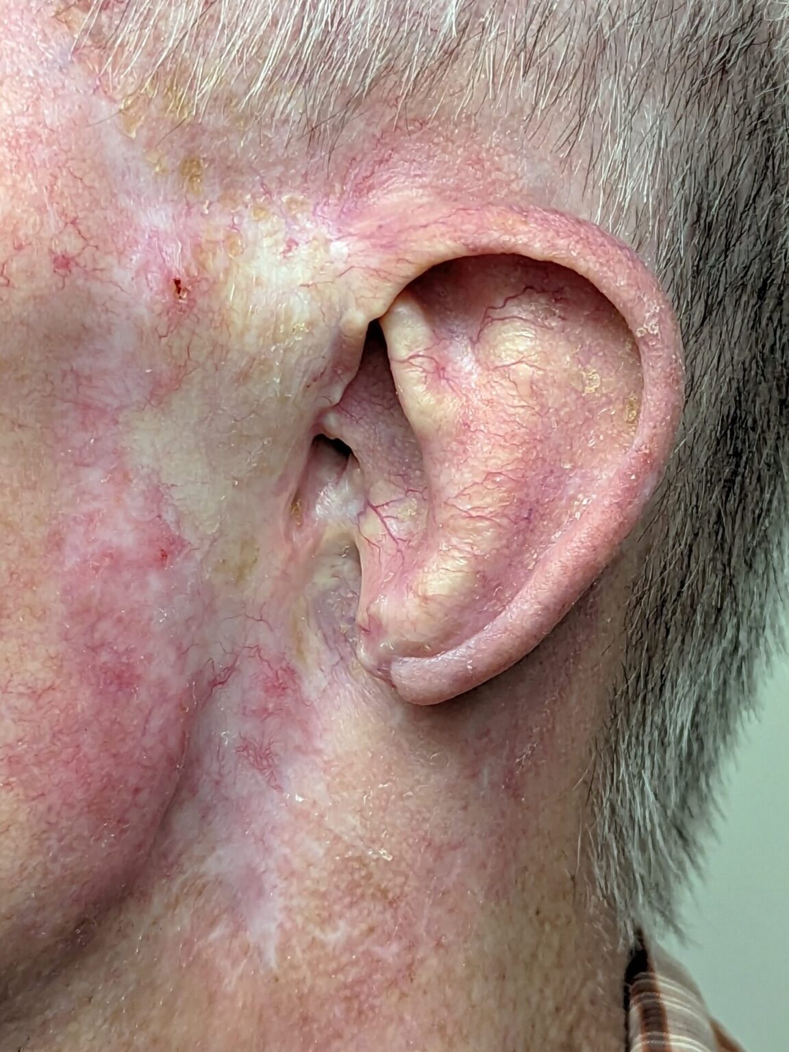 Ear Prosthetics, human ear