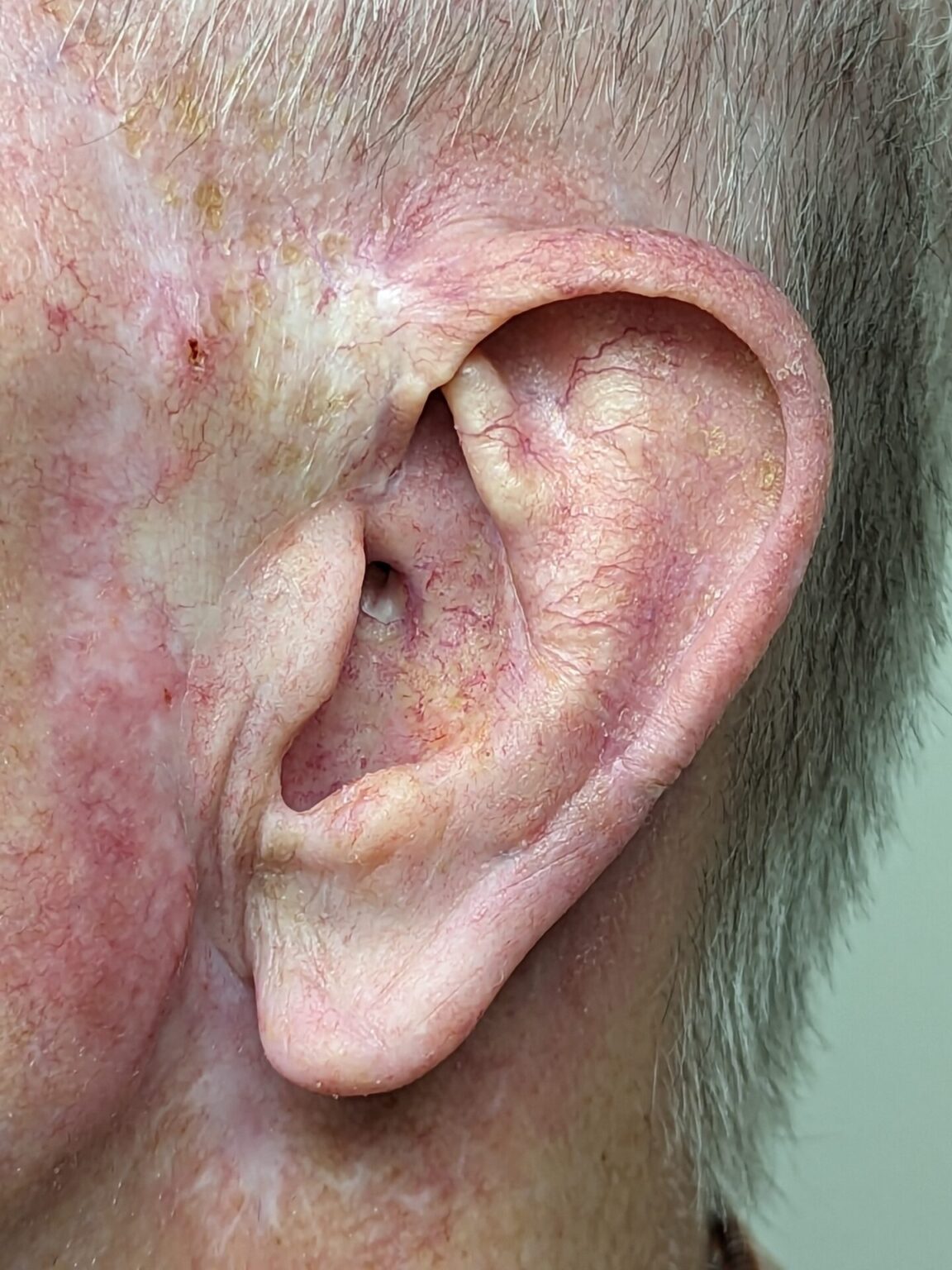 Ear prosthetics, close-up ear