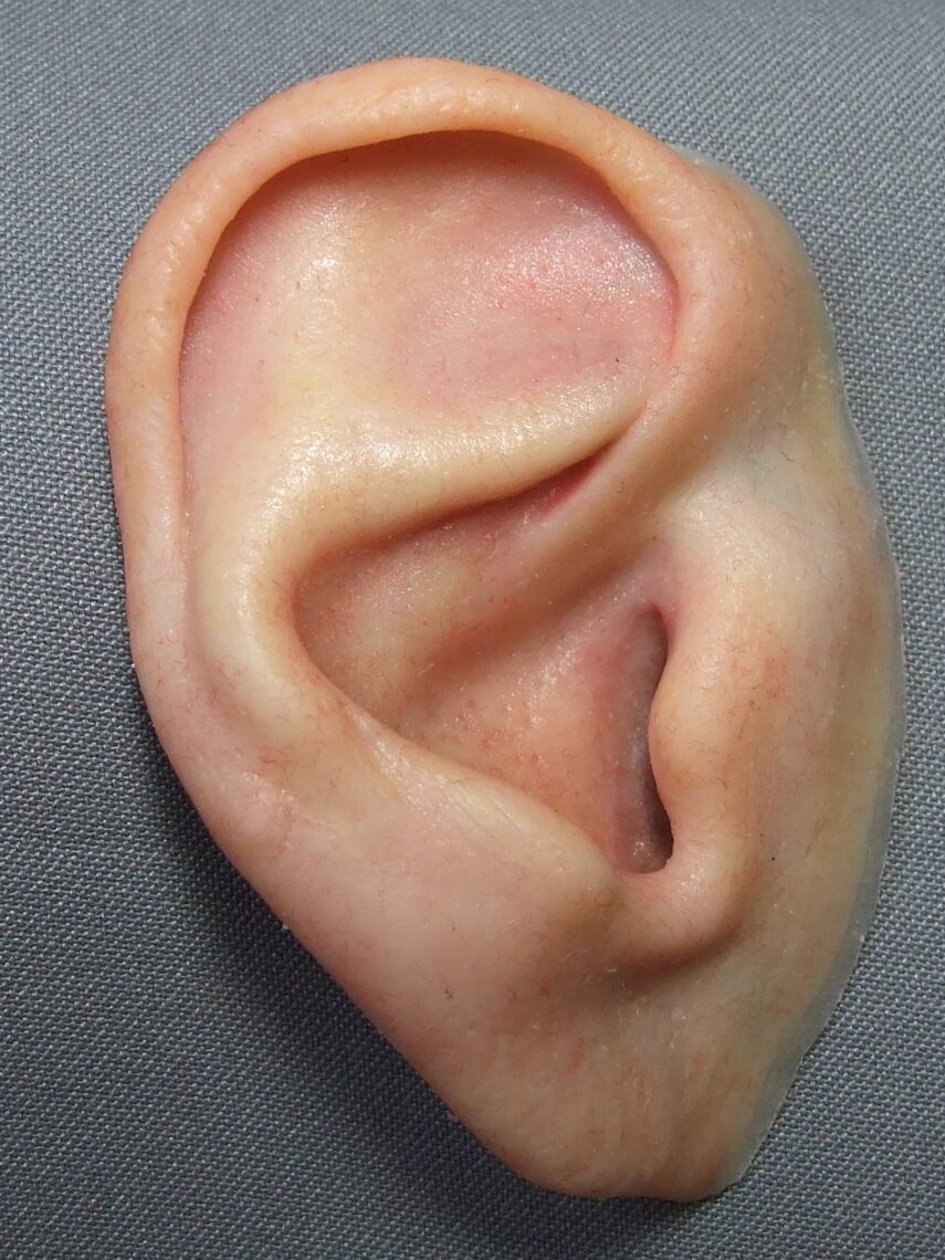 bar clip ear prosthesis front