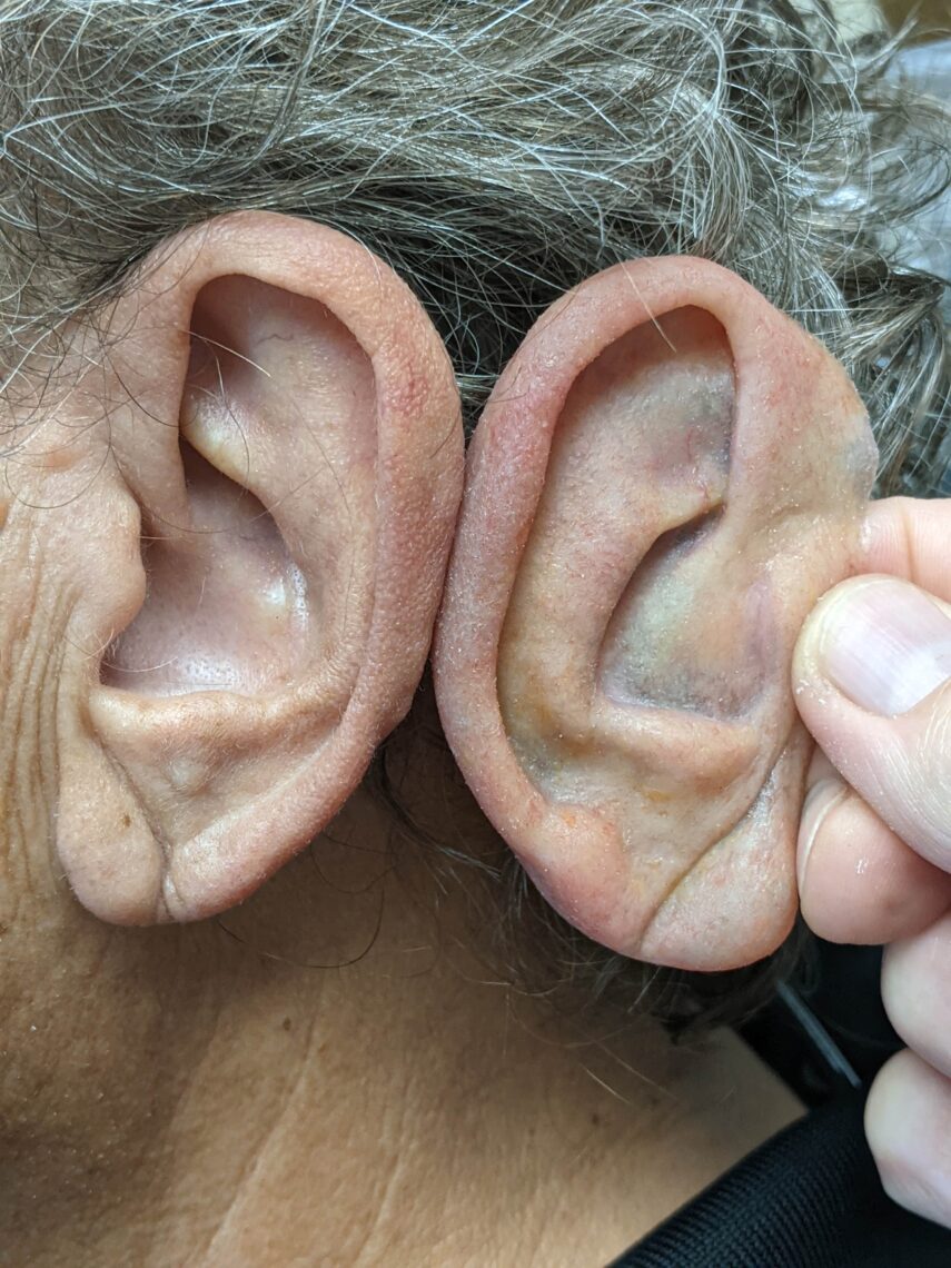 super thin prosthetic ear improves look of suboptimal ear reconstruction