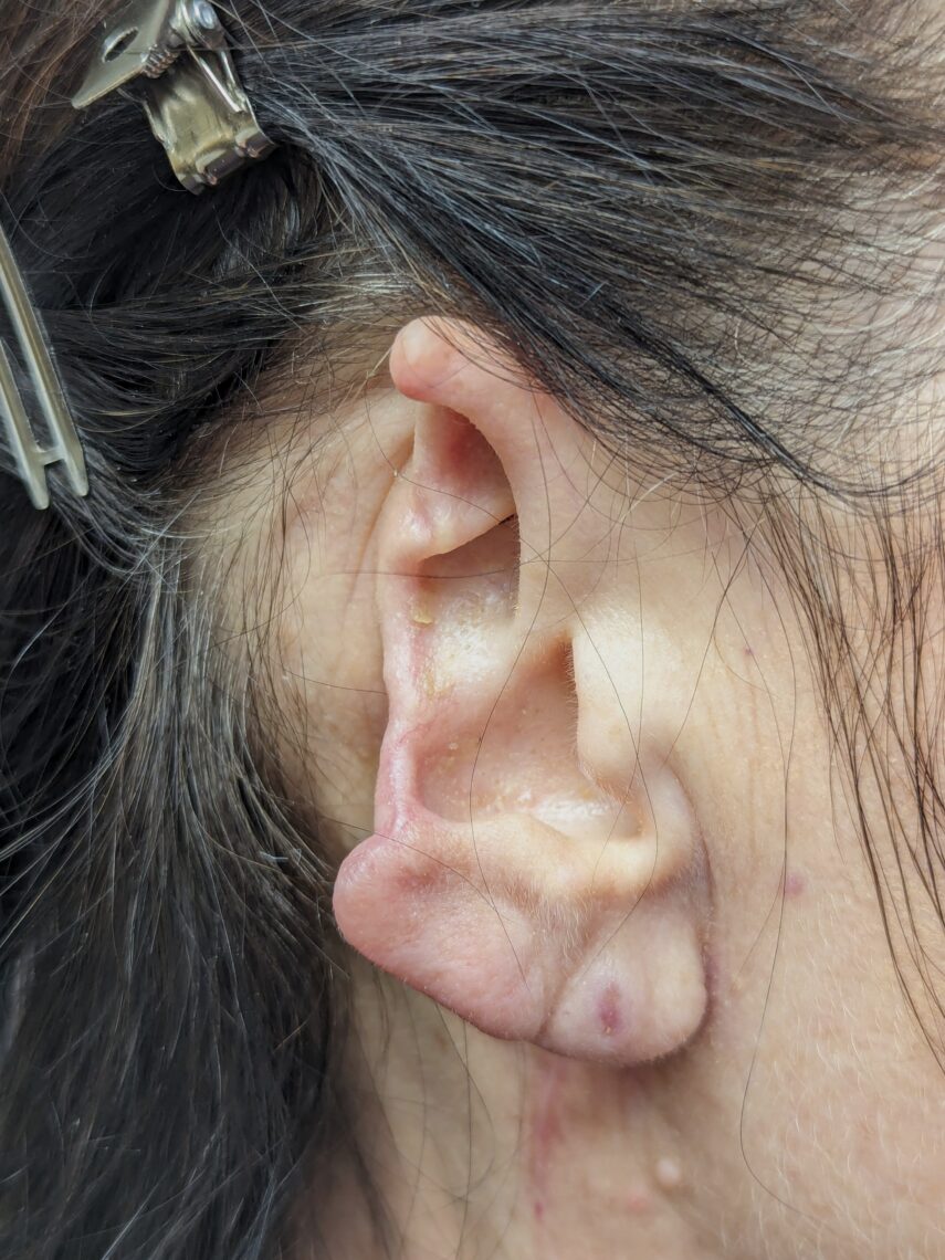 shark bite subtotal rhinectomy